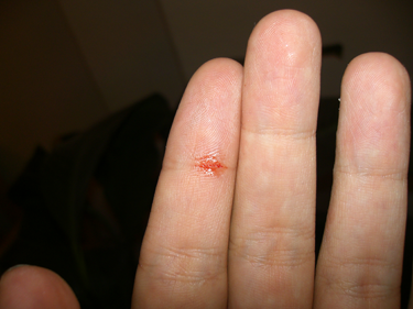 Zeigefinger mit einem 1 cm breiten Einstichloch